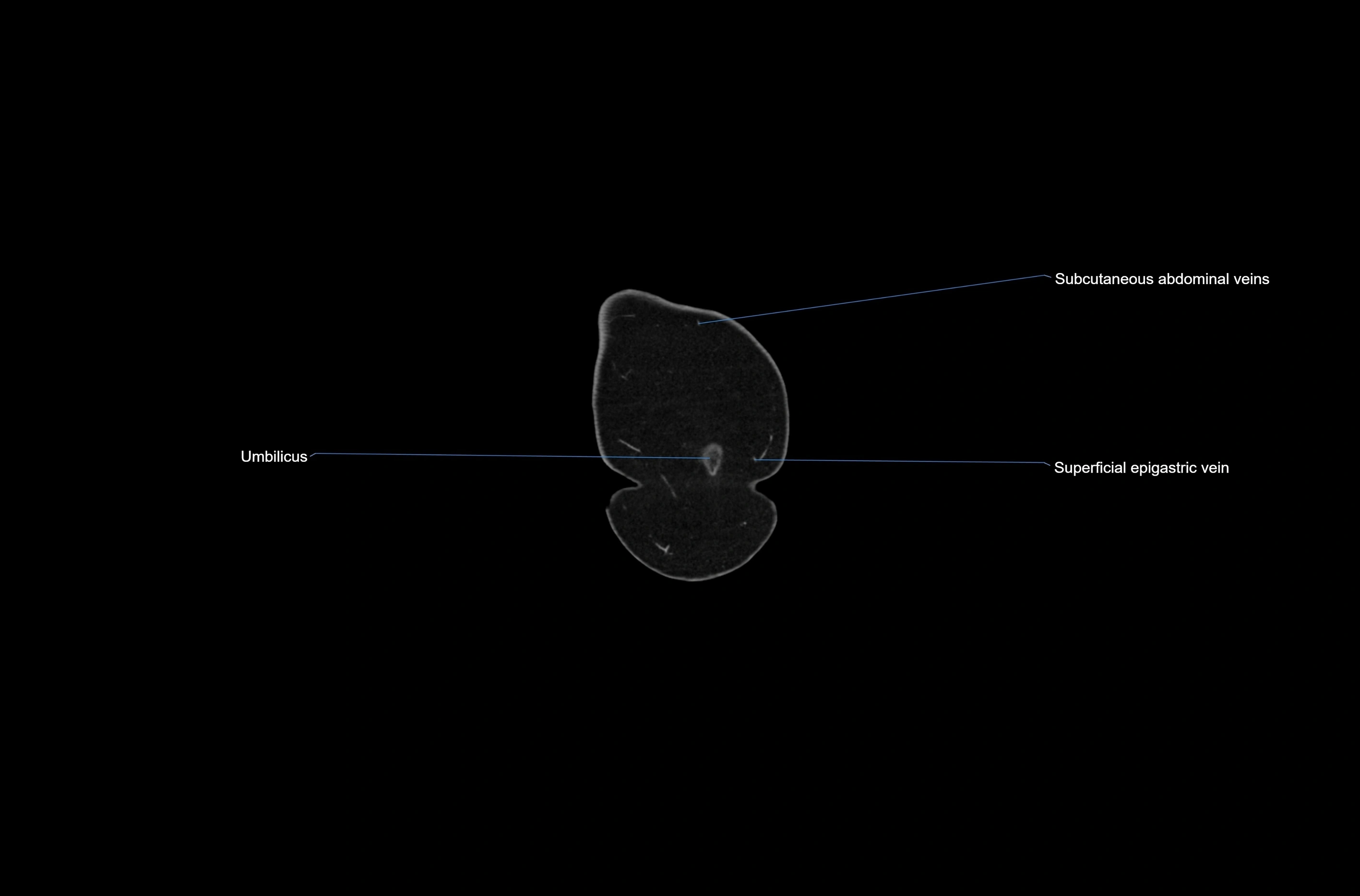CT abdomen coronal cross sectional anatomy labelled radiology image-00001.webp